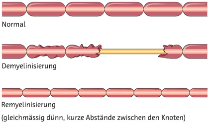 Illustration Demyelisierung