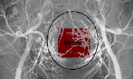 Geb�rmutter R�ntgenaufnahme Myom (rot)