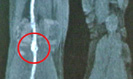 Beinvenenthrombose