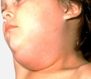 Mumps