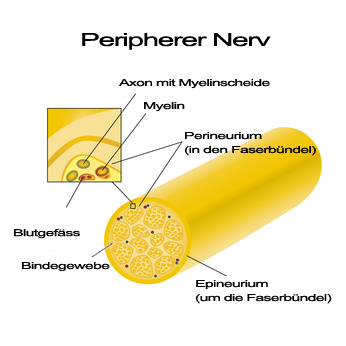 Illustration Demyelisierung