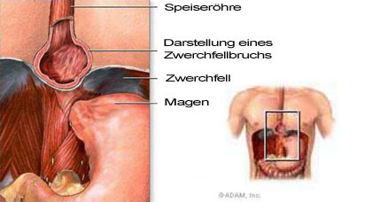 Reflux Zwerchfellbruch