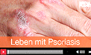 Hautpflege bei Psoriasis