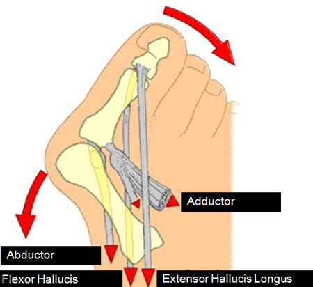 Hallux valgus Fehlstellung