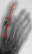 Gelenksnahe Korrektur Hallux valgus