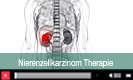 Nierenzellkarzinom Therapie