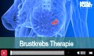 Therapie Brustkrebs