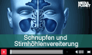 Sinusitis