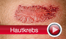 Hautkrebs - Pr�vention