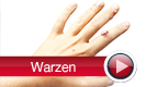 Warzen