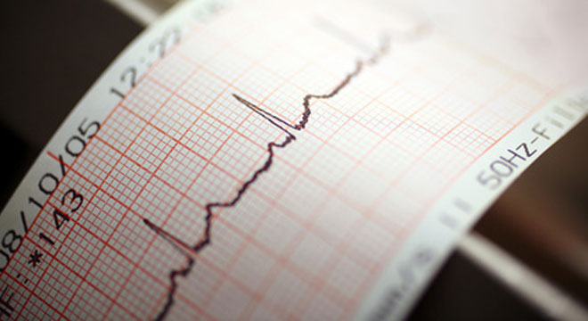 Langzeit-EKG: 24-Stundenaufzeichung der Herzströme
