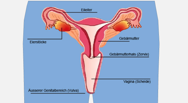 Senkung gebärmutter wie der sieht aus eine Gebärmuttersenkung, Scheidensenkung: