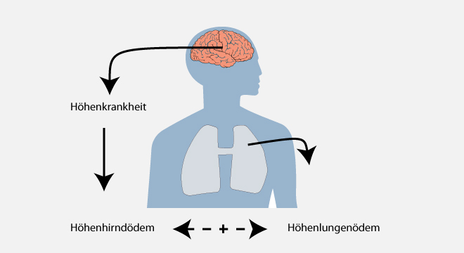 Höhenkrankheit: Krankheitsverlauf