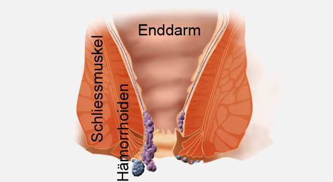 Hämorrhoiden als Knoten im Analkanal