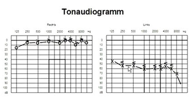 Hörsturz: Audiogramm, Aufzeichnung der Hörfunktion