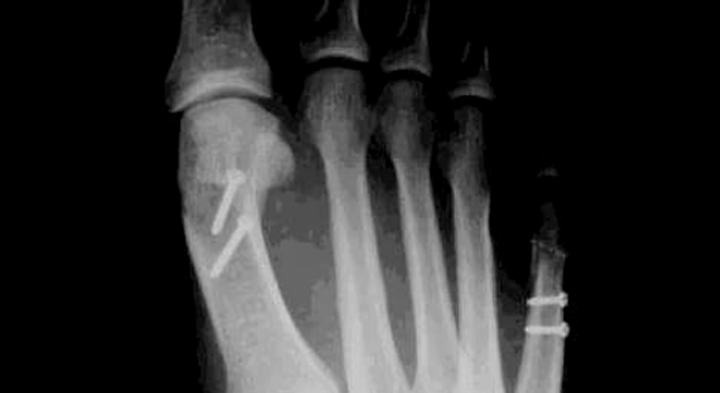 Hallux valgus: Muss meist operiert werden