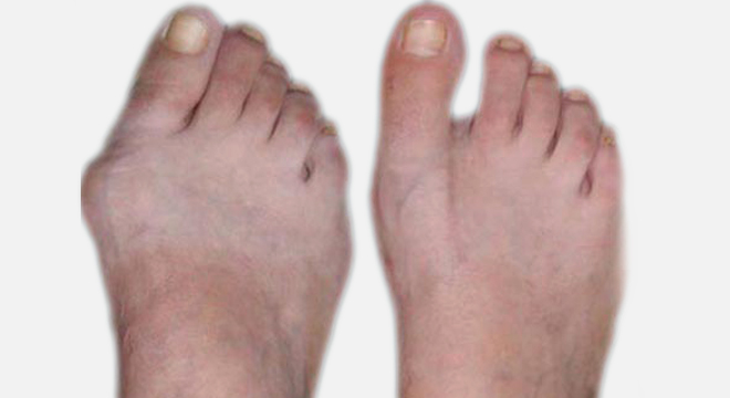 Hallux valgus: Fussfehlform des grossen Zehen