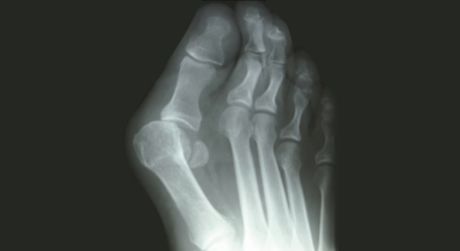 Hallux valgus im Röntgenbild