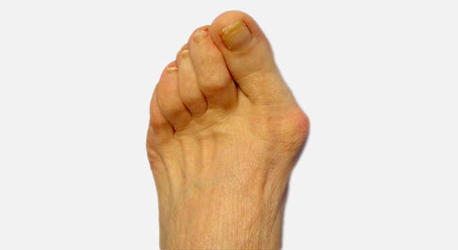 Hallux valgus: Schmerzen aufgrund entzündetem Schleimbeutel