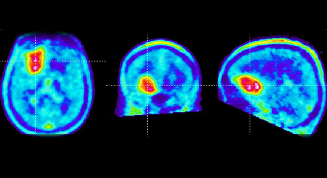 Echoenzephalographie: Ultraschallaufzeichnungen des Schädels