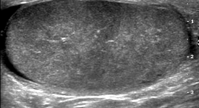 Hodenentzündung: Ultraschall zum Ausschluss anderer Erkrankungen