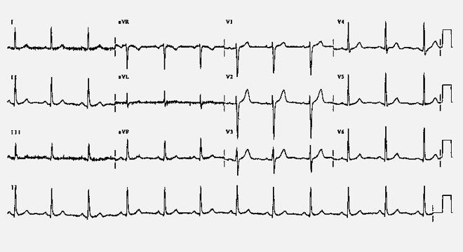 Kammerflimmern: Aufzeichnen der Herzströme (EKG)