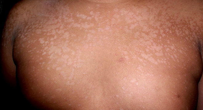 Ansteckend kleienpilzflechte Pityriasis versicolor