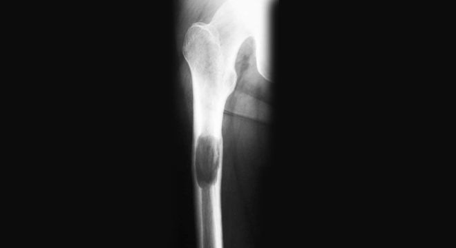 Knochenkrebs: Knochentumor im Röntgenbild