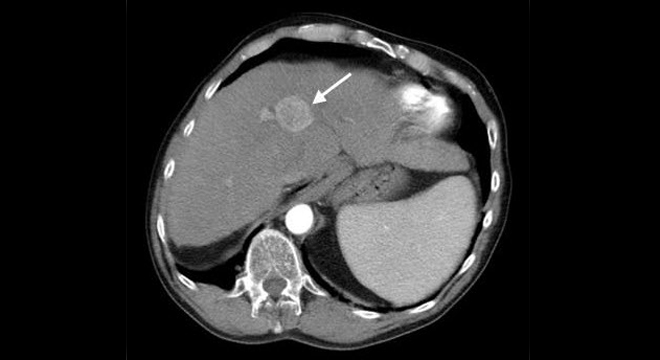 Leberkrebs: Computertomographie zeigt Tumor in der Leber