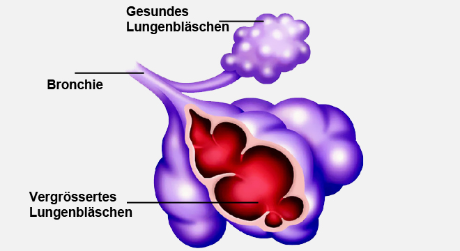 Lungenblähung oder Lungenemphysem