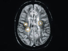 MS Illustration MRI Gehirnl