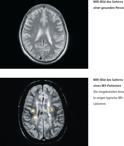 MS MRI gesundes und betroffenes Gehirn