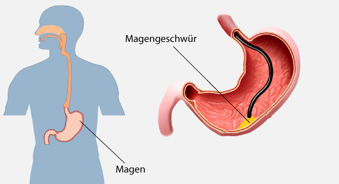 Magengeschwür: Geschwüre in der Magenschleimhaut