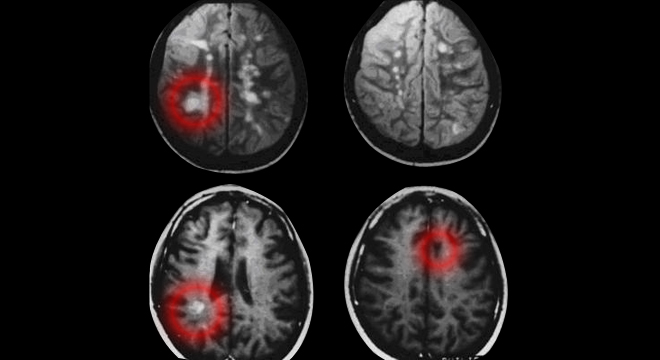 Multiple Sklerose: MRI zeigt Plaques im Gehirn