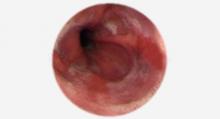 Refluxkrankheit: Magenspiegelung zeigt Entzündungen der Speiseröhre