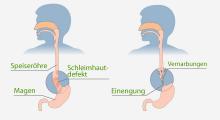Refluxkrankheit: Schädigung der Schleimhaut der Speiseröhre