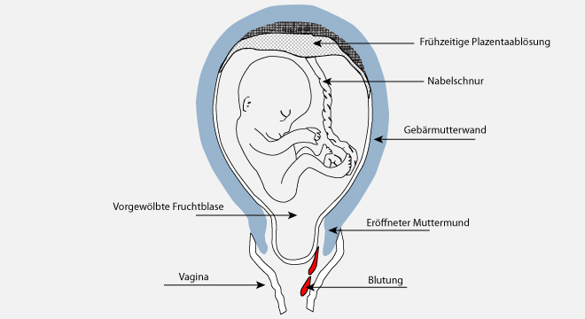 Fehlgeburt: Fötus im Uterus. 