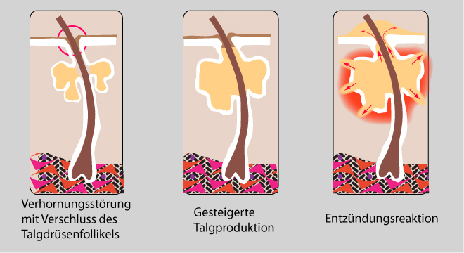 Verlauf der Akne