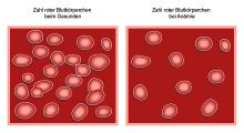 Anämie: Die Blutarmut durch verringerte Anzahl roter Blutkörperchen