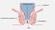 Analfissur: einriss der Haut oder Schleimhaut