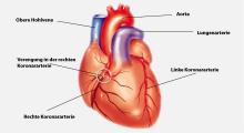 Angina pectoris: Durchblutungsstörung der Herzkranzgefässe