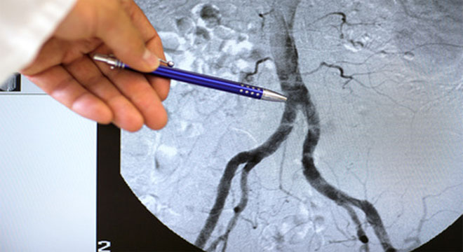 Die Angiographie ist eine Röntgenuntersuchung zur Darstellung der Blutgefässe mittels Kontrastmittel