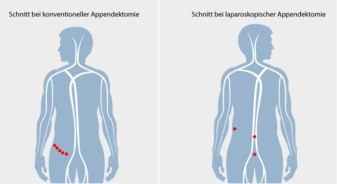 Ist eine dass zyste geplatzt wie man merkt