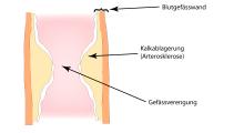 Arterienverkalkung: Zunehmende Gefässverengung