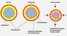 Asthma: Entzündete Atemwege