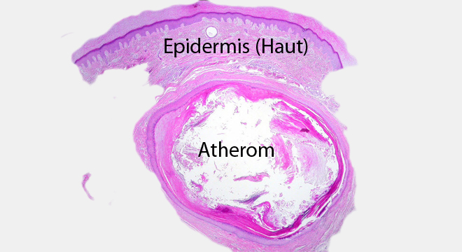 Penis entzündete talgdrüse Entzündete Talgdrüse