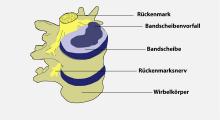 Bandscheibenvorfall: Degenerative Veränderungen an Bandscheiben