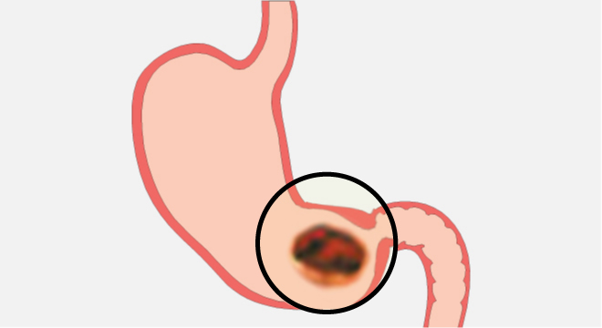 Bauchfellentzündung: Lokale Peritonitis