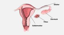 Bauchhöhlenschwangerschaft: Das Ei nistet sich ausserhalb der Gebärmutter ein
