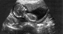 Bauchhhölenschwangerschaft: Ultraschalluntersuchung